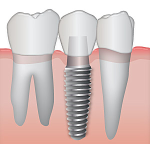 Implanturi dentare – pro si contra